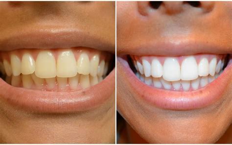 Are Teeth Whitening Strips Effective? | New Jersey Orthodontics