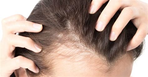 Alopecia: What Is It, What Are Its Symptoms And How To Treat? - KNOWLEDGE Lands