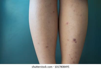 Dark Spots On Legs