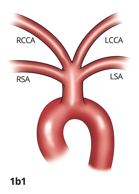 Cureus | Anatomical Variations in Aortic Arch Branching Pattern: A Computed Tomography ...