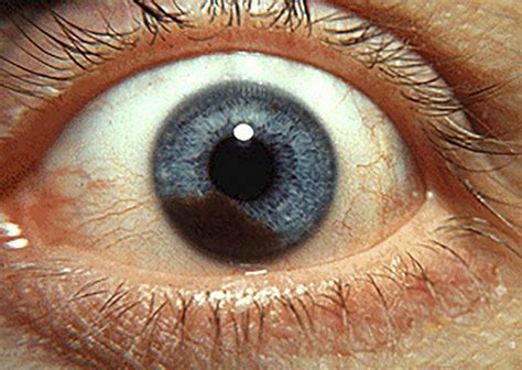 Conjunctival Melanoma