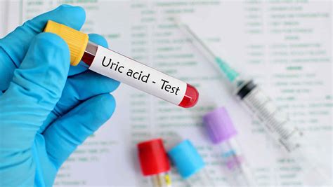 Hyperuricemia causes, signs, symptoms, diagnosis, diet & treatment