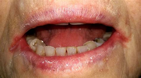 Queilite angular - Angular cheilitis - abcdef.wiki