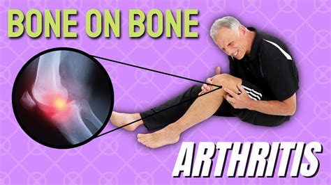 Bone on Bone Knee Arthritis and Pain: TOP 3 Things to Try. - Capsaicin ...