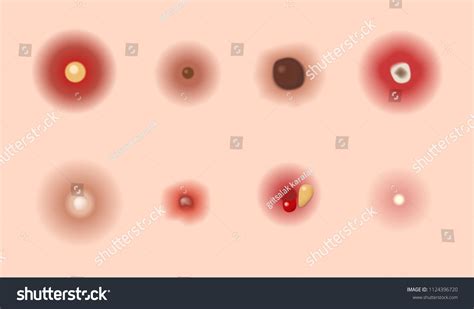 Pimple Images: Browse 68,973 Stock Photos & Vectors Free Download with Trial | Shutterstock