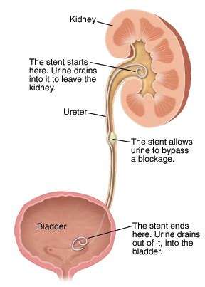 Ureteral Stent