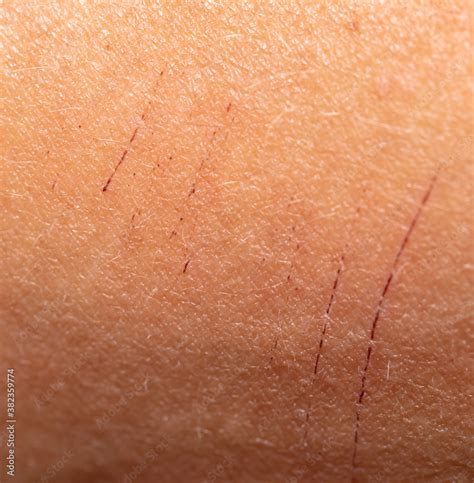 Scratches on human skin as background. Stock Photo | Adobe Stock