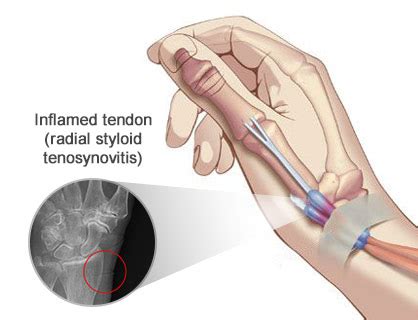 Radial Styloid Tenosynovitis Treatment Doctors in Brooklyn NYC