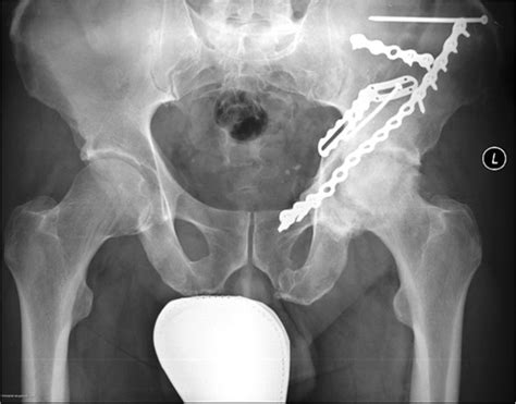 Post-surgical image of acetabular fracture | Download Scientific Diagram