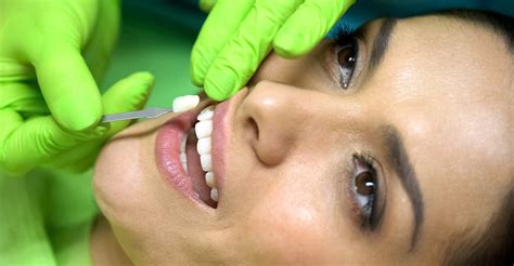 How long do dental veneers last? | Caldwell, Bills, Petrilli & West