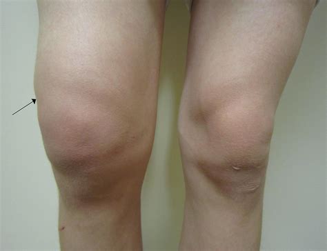 What Does Fluid In My Knee Mean at Charles McClung blog