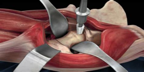 How Effective Is An Anterior Hip Replacement? - Aditi Corporation