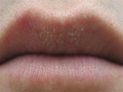 How To Treat Fordyce Spots On Lips Reddit | Lipstutorial.org