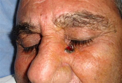 Basal Cell Carcinoma - Causes, Types, Symptoms, Prognosis, Treatment