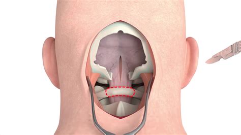 Craniectomy procedural 3D animation - YouTube