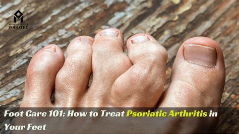 Foot Care 101: How To Treat Psoriatic Arthritis In Your Feet