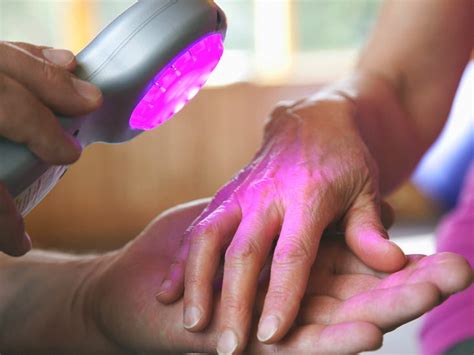 XTRAC Laser Therapy for Psoriasis: Does It Work?