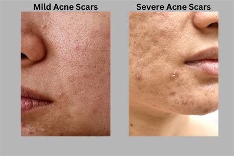 Erase Acne Scars With PRP Microneedling — TavieMD MedSpa