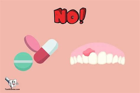 Will Tooth Abscess Return After Antibiotics? No, 6 Factors