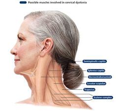 Spasmodic Torticollis - Jonathan Aarons MD/ Pain Management