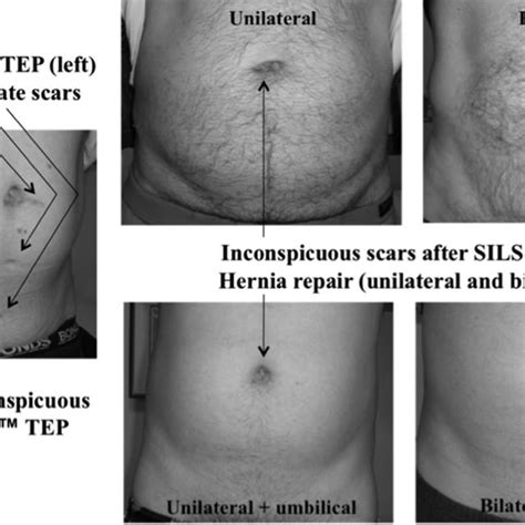 Single-incision laparoscopic inguinal hernia repair with or without... | Download Scientific Diagram