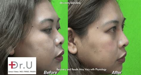 VIDEO: Nose Job Without Plastic Surgery | Low Nose Bridge Injection Results