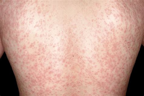 PITYRIASIS ROSEA - Stamford Skin Centre