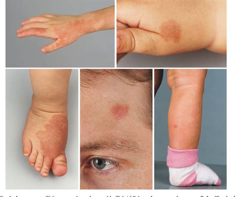 Figure 1 from The potential of capillary birthmarks as a significant ...