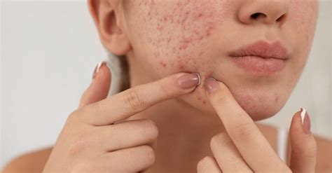 Blemishes On Face: Types, Causes & Home Remedies