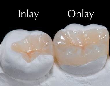 Inlays and Onlays - Brushwell Dental & Implants