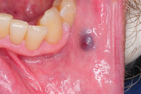 Oral Hemangioma Appearing as a Blue-Purple Lesion | Oral Hemangioma ...