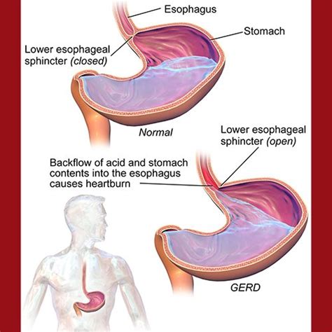 Stop Heartburn: Improve Stomach Acid with One Simple Drink | Stellar ...