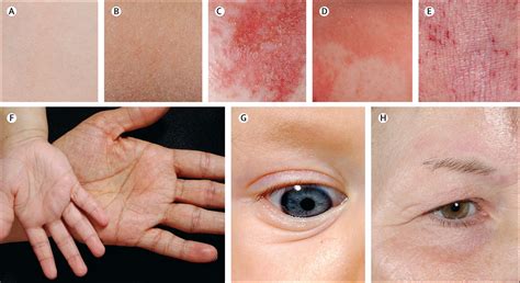 Mild Atopic Dermatitis Face