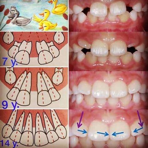 What is a Diastema? Causes, and prevention. - GenMiles