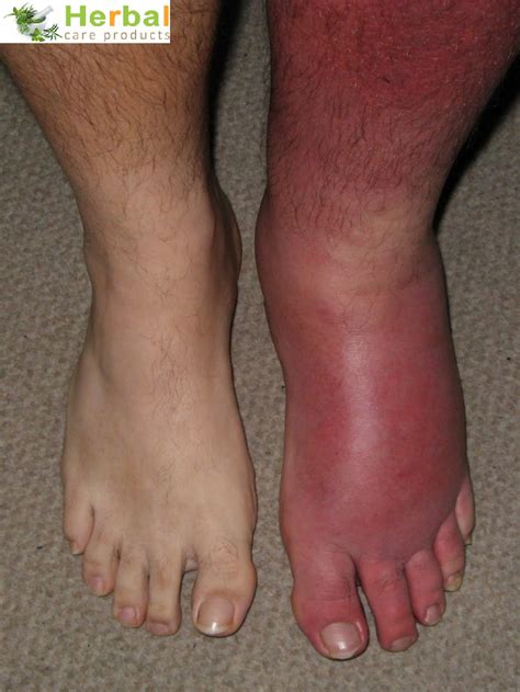 Cellulitis Pictures, Symptoms, Treatment & Complications