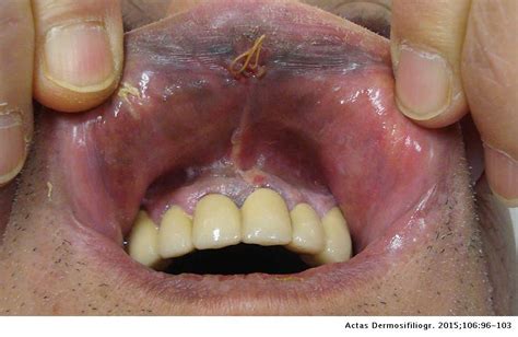 Melanoma Oral Mucosa