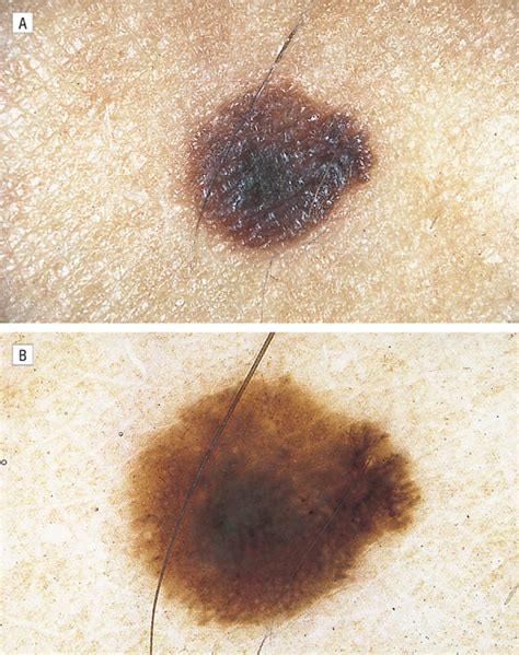 Is Dermoscopy Useful for the Diagnosis of Melanoma? | Dermatology | JAMA Dermatology | JAMA Network