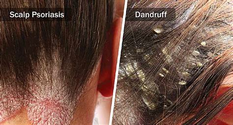 Itchy Scalp And Dandruff : ITCHY DRY SCALP | SCRATCHING DANDRUFF ...