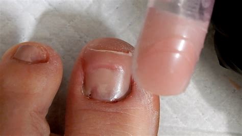 Discover more than 135 fake toenails for missing nail latest - ceg.edu.vn