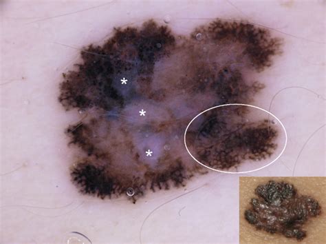 Melanoma Dermoscopy