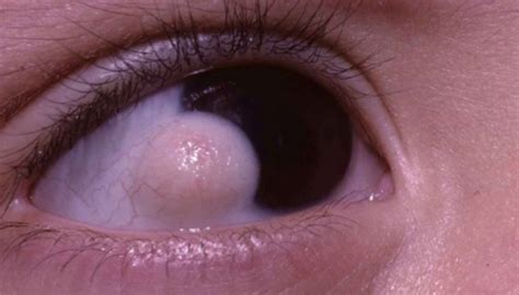 Bump on Eyeball: Causes, Pictures, (Yellowish, White, Clear), Treatment ...