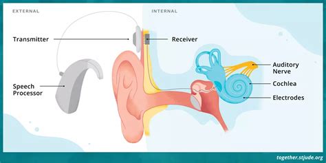 Cochlear Implants for Hearing Loss - Together