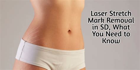 Laser Stretch Mark Removal, What You Need to Know