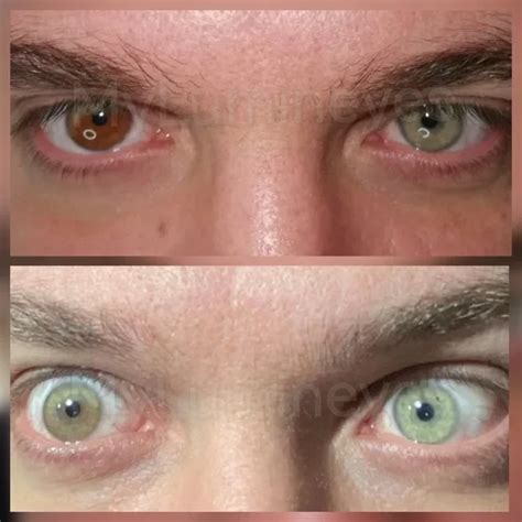 Heterochromia Treatment With Laser - Causes Of Heterochromia