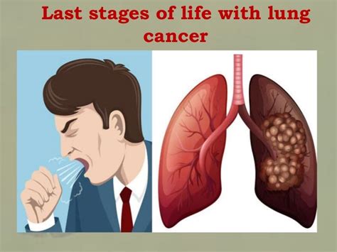 What Are The Symptoms Of Lung Cancer Stage 4 / Non-Small Cell Lung Cancer Treatment (PDQ ...