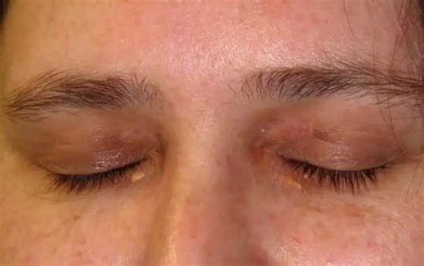 Xanthelasma Removal in Sydney - Safe and Effective Treatments