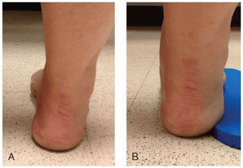 Cavovarus Deformity | Musculoskeletal Key