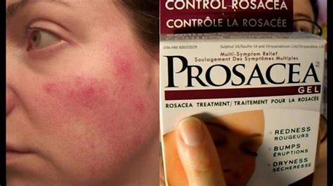 Prosacea? Anyone Familiar With This Product? R/Rosacea, 52% OFF