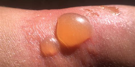 How to Get Rid of Sunburn Blisters With Aloe, a Cool Compress, and More