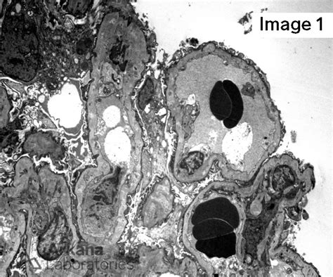 Membranous Nephropathy | Teaching Point | Arkana Laboratories